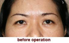 plastic-surgery-blepharoplasty